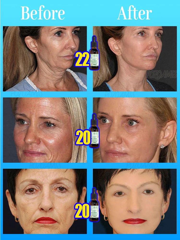 20 years younger, 100% wrinkles disappear